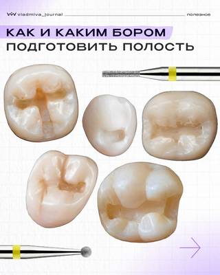 Препарирование полости: какой бор выбрать?